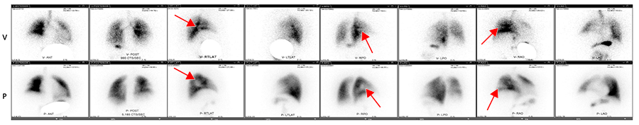 Abnormal VQ scan.